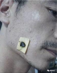 艾灸治疗面瘫视频,视频教程详解